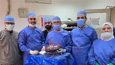 فريق طبي بمستشفى الحسين ينجح في إجراء عملية دقيقة لاستئصال ورم بالطحال