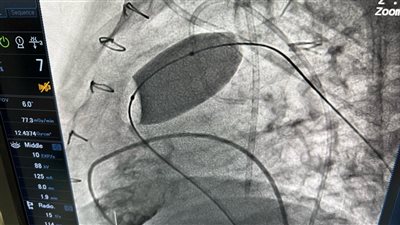نجاح عملية دقيقة لتغيير الصمام الرئوي بالقسطرة في أكاديمية قلب المبرة