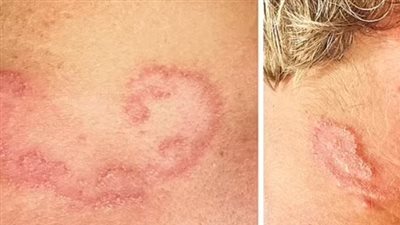 هل يمكن أن تكون مصابًا بالديدان دون أن تعلم؟ إليك أهم الأعراض 