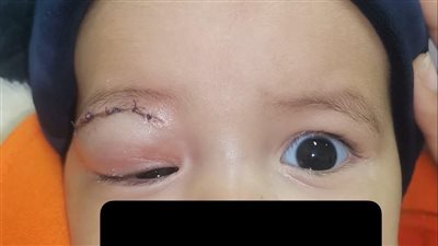 مستشفي سوهاج الجامعي تنقذ عين رضيعة تبلغ من العمر 6 أشهر