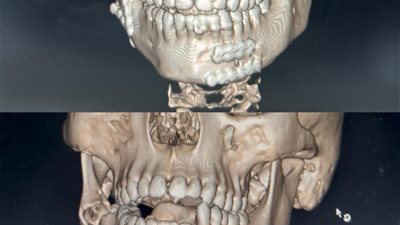  فريق طبى بمستشفى شربين ينجح  فى إجراء أولى جراحات الوجه و الفكين بالدقهلية