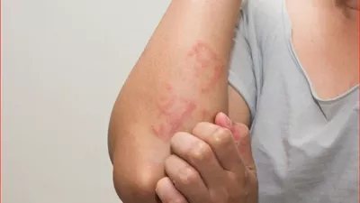 علماء يكشفون عن أضرار خفية لفيروس الهربس