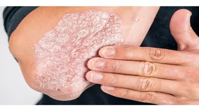 علماء يكتشفون علاج واعد للصدفية بدون آثار جانبية