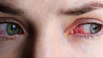 كيف تحمي عينيك من الغبار والعواصف الرملية| خطوات بسيطة للحفاظ عليهما