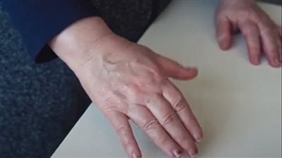 علامات مبكرة لمرض باركنسون لا يعرفها الكثيرون