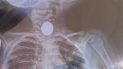 إنقاذ طفل من خطر الاختناق بعد ابتلاعه عملة معدنية بالشرقية