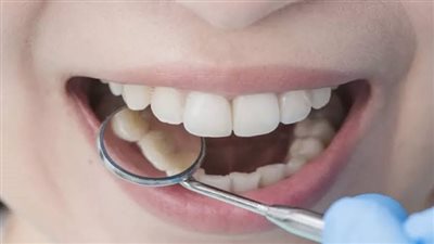 5 أشياء ابتعد عنها للحفاظ على أسنانك لامعة وقوية