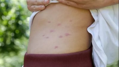 كيف تعامل مع لدغات الناموس؟  حلول منزلية فعالة ونصائح للوقاية