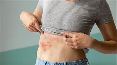 دراسة تحذر: فيروس الهربس يزيد خطر الإصابة بالخرف 7 مرات 