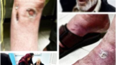 «الجرب» و«والأميبا» ينهشان أرواح الأسرى الفلسطينيين بسجون الاحتلال