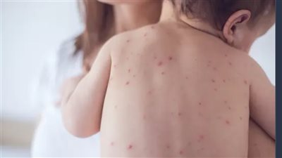 الحصبة تجتاح خُمس الولايات الأمريكية والحالات تناهز الـ 900