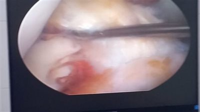 فاقوس المركزي يدشن وحدة مناظير الركبة ويُجري أول عملية لإصلاح الرباط الصليبي