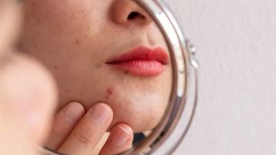 دراسة: الإصابة بحب الشباب تزيد مخاطر التعرض للاضطرابات الغذائية