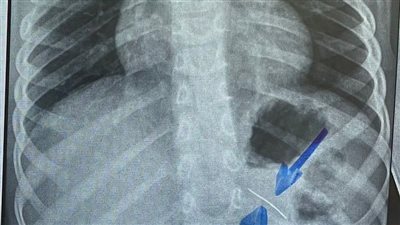 استخراج دبوس من معدة طفل بمستشفى سوهاج الجامعي 