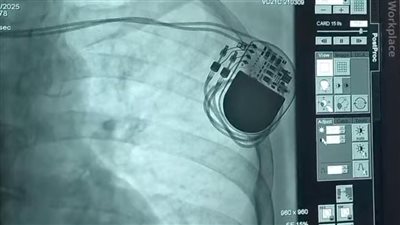 انقاذ حياة مسنة بتركيب منظم ضربات قلب دائم بالإسكندرية 