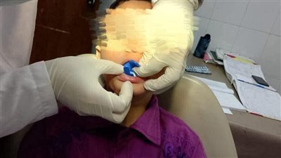 صحة الإسكندرية تطلق حملة ضد تسوس أسنان الأطفال 