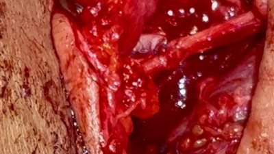 نجاح جراحة لإصلاح عصب حسي في اليد بمستشفى السنبلاوين