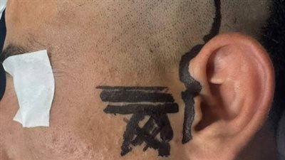 مستشفى العامرية ينجح في انقاذ العصب السابع لأحد المرضى بالإسكندرية 