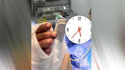  إنقاذ يد مريض من البتر بمستشفى السنبلاوين العام بالدقهلية 