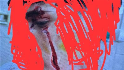 طالب ثانوي في الدقهلية يتعرض لحفلة تعذيب على أيدي 3 أشخاص