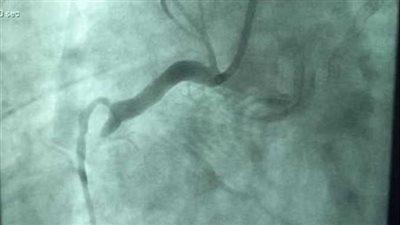 «العودة من الموت».. إنقاذ مريض بجلطة بالشريين في الإسكندرية 