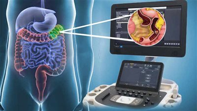 سونار الأمعاء أحدث تقنيات تشخيص أمراض الجهاز الهضمي