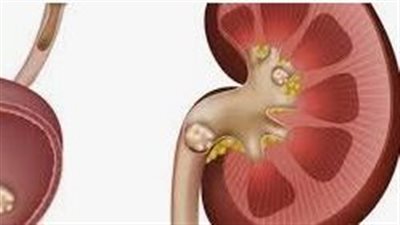 المشروبات الغازية أصابته بـ35 حصوة كلوية