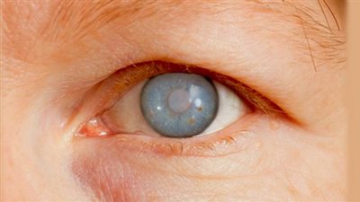 ابتكار خارق.. باحثون روس يبتكرون دعامة مجهرية لجراحة الغلوكوما 