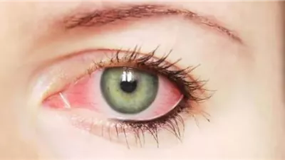 نصائح طبية لعلاج التهاب القزحية