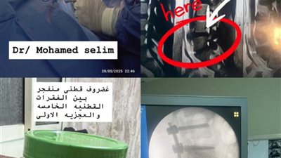  مستشفى تمي الأمديد بالدقهلية تنجح فى إنقاذ شاب من الشلل