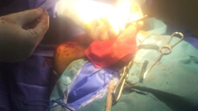 نجاح أول جراحة مخ وأعصاب بمستشفى بلقاس بالدقهلية