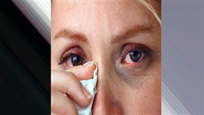 احذر: التهاب العصب البصرى يسبب العمى