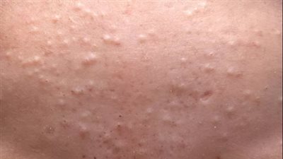 أسباب ظهور الرؤوس البيضاء وطرق الوقاية منها