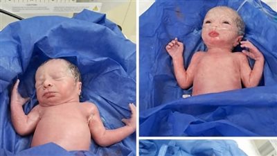 ولادة 3 توائم بمستشفى العدوة المركزي.. حالة فريدة من نوعها