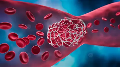 علماء يبتكرون جهاز ثوري لإزالة الجلطات الدموية من الجسم