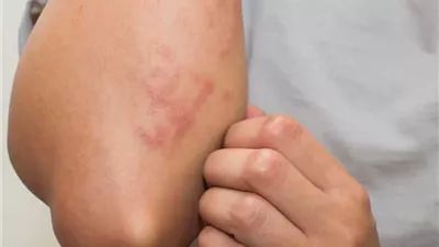 أخطر المسببات الشائعة للحساسية الجلدية