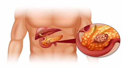 طبيب يوضح الأعراض الرئيسية لأمراض البنكرياس