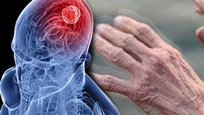 هل لنظافة الفم علاقة بمرض باركنسون القاتل؟.. دراسة توضح