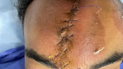 جراحات معقدة بالمخ والوجه تنقذ حياة طفلة وشاب بمستشفيات تمى الأمديد