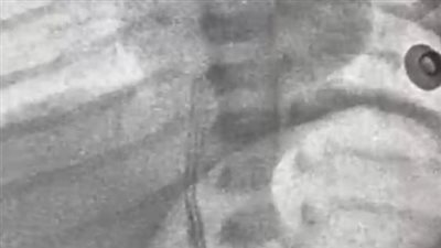 إنقاذ حياة رضيع في معهد القلب بفضل التدخل الطبي العاجل 