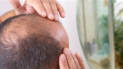 باحثون يبتكرون علاج واعد للصلع يحقق نتائج مذهلة