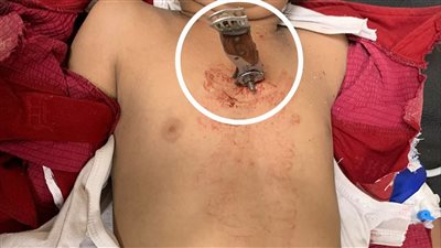 إنقاذ طفل مصاب بطعنة نافذة بمستشفيات سوهاج الجامعية