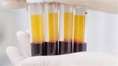 هل يمكن لعلاج استبدال البلازما إطالة عمر الإنسان؟