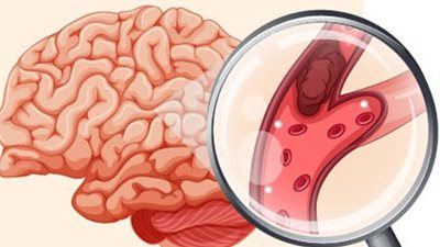 انتبه.. علامات خفية للجلطة الدماغية الدقيقة