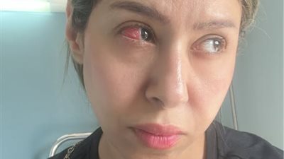 كل ده بسبب خطأ طبي..  إيناس عز الدين تجري عملية عاجلة في عينها (صور)