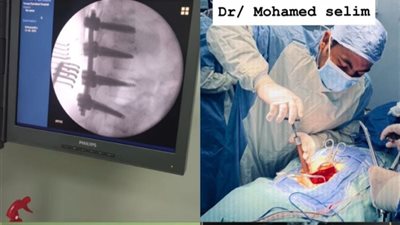 صحة الدقهلية: جراحات دقيقة تنقذ 3 مريضات من الشلل بمستشفى تمي الأمديد