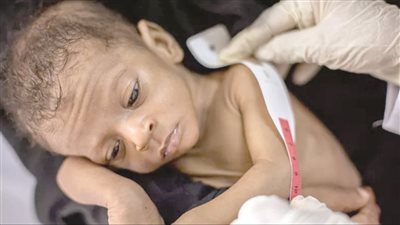 شبح التقزم يحاصر أطفال مصر