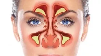 ابتكار طريقة لعلاج الجيوب الأنفية دون الحاجة للأدوية