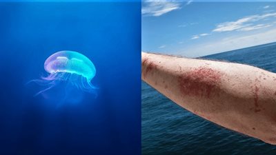 خبير يوضح كيف نحمي أنفسنا من لسعات قناديل البحر