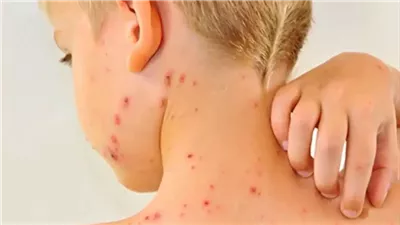 الولايات المتحدة تواجه أسوأ تفش للحصبة منذ أكثر من 30 عامًا